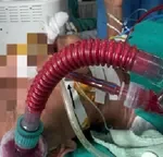 Thoát chết ngoạn mục nhờ nút tắc động mạch vú trong hiếm gặp